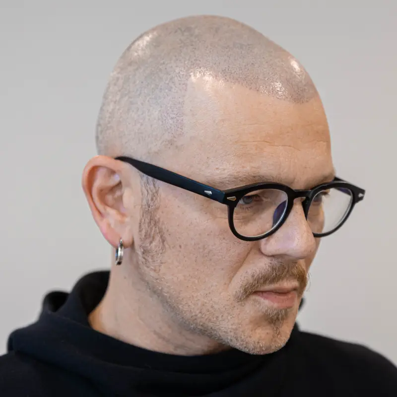 Hair scalp pigmentation, Trikopigmentation