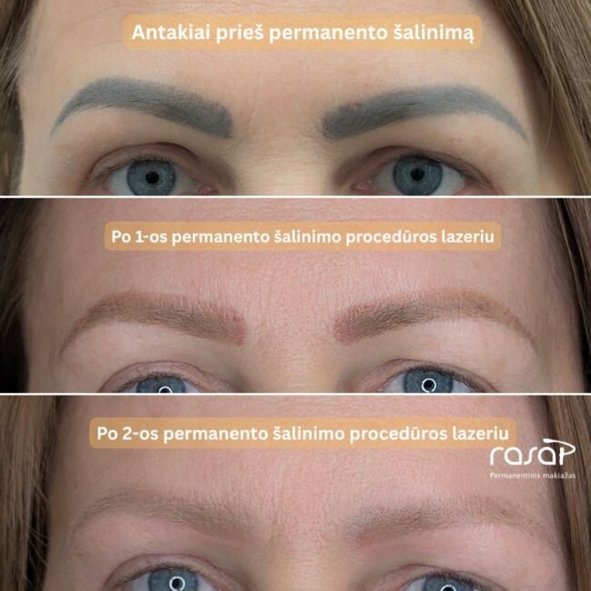 Trys moteru antakiu nuotraukos. Vienu labai tamsūs vaizduojantys kaip atrodo antakiai prieš šalinima ir trečioji nuotrauka rodo šviesius antakius, kaip jie atrodo po šalinimo